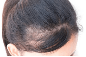 How to grow side hair naturally